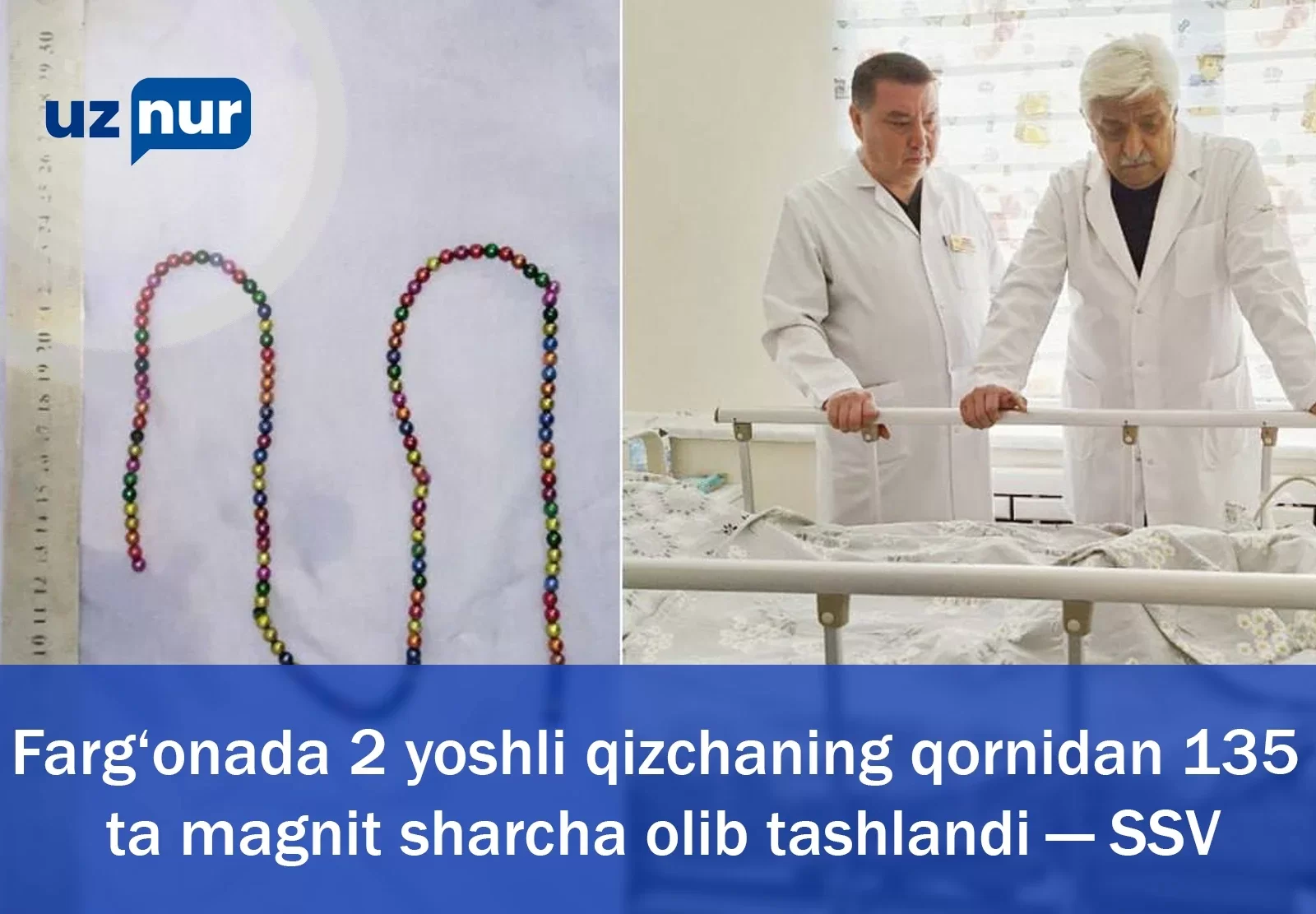 Farg‘onada 2 yoshli qizchaning qornidan 135 ta magnit sharcha olib tashlandi — SSV