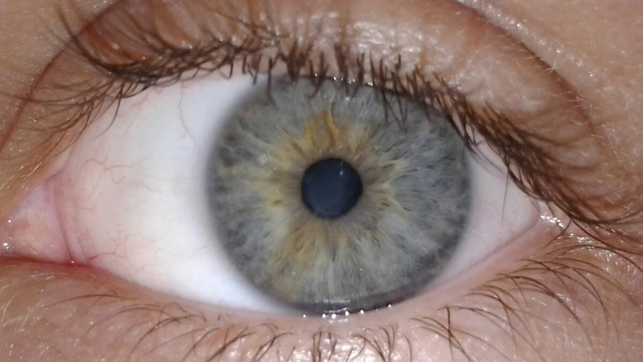 Omskda shifokorlar ayolning ko‘zidan tirik qurt olib chiqishdi